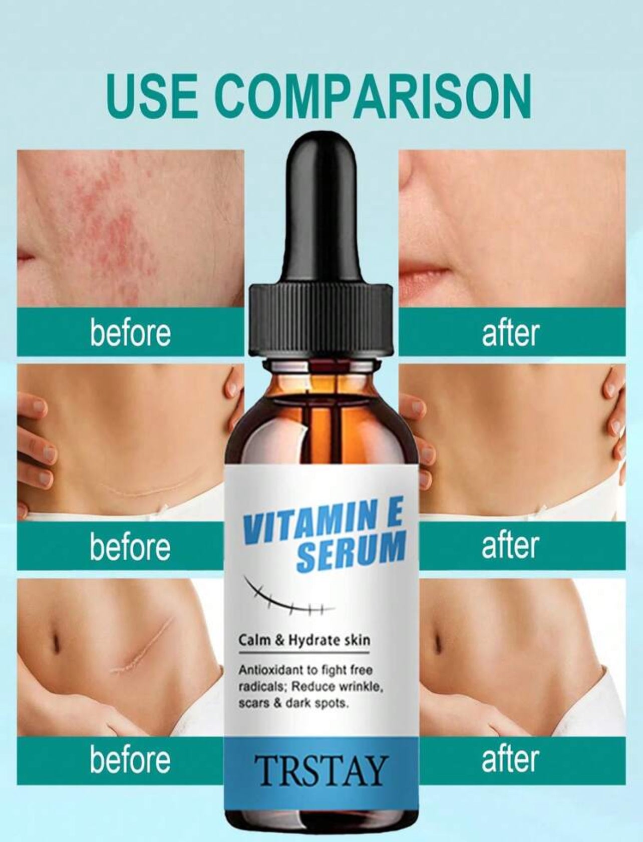 Stretch marks serum vitamin E