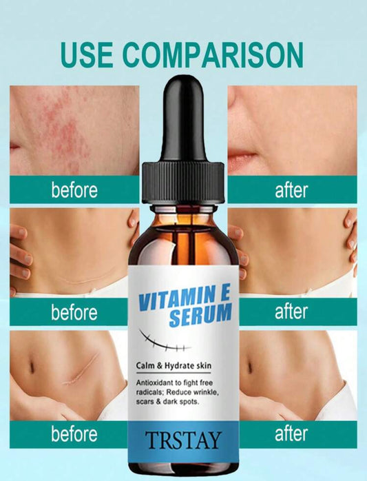 Stretch marks serum vitamin E