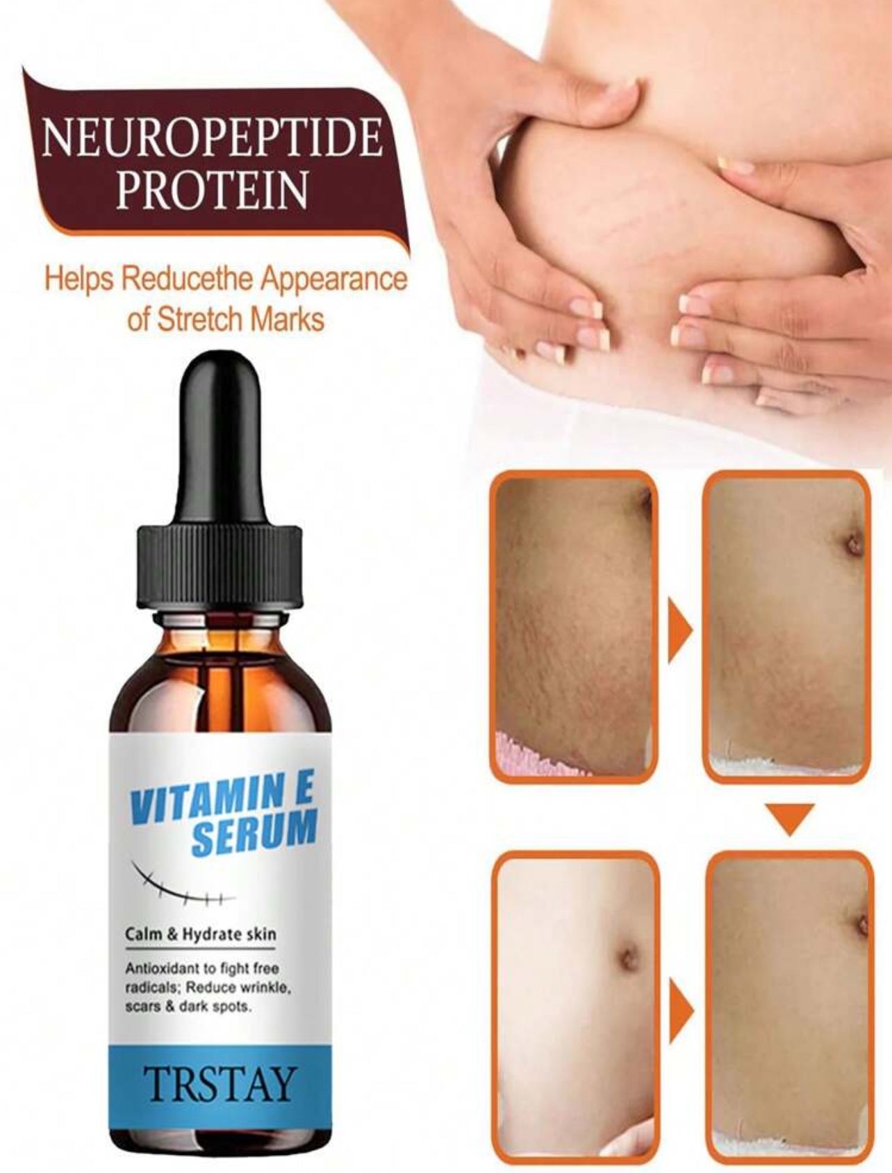 Stretch marks serum vitamin E